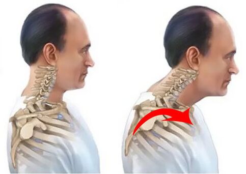 Healthy and sick vertebral column