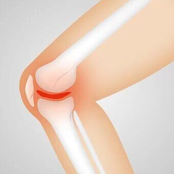 osteoarthritis is a non-inflammatory joint disease